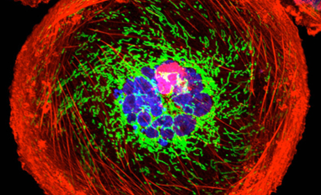 Illustration of breast cancer cells