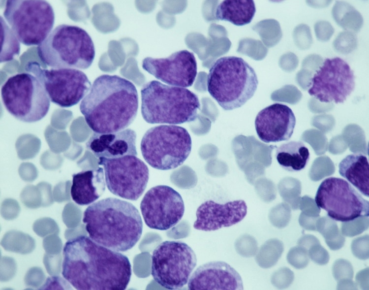 Microscopic view of blood cancer cells