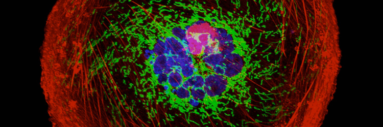 Illustration of breast cancer cells