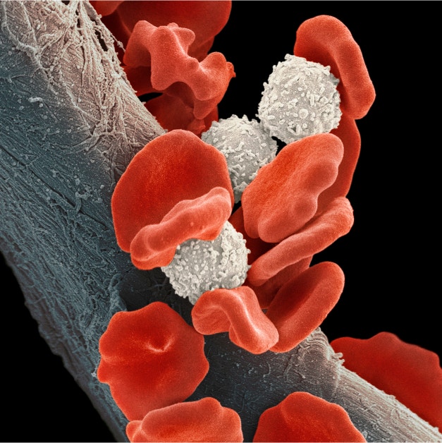 Blood cancer cells and blood cells