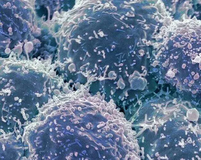 A colored scanning electron micrograph (SEM) showing a cluster of lung cancer cells mobile