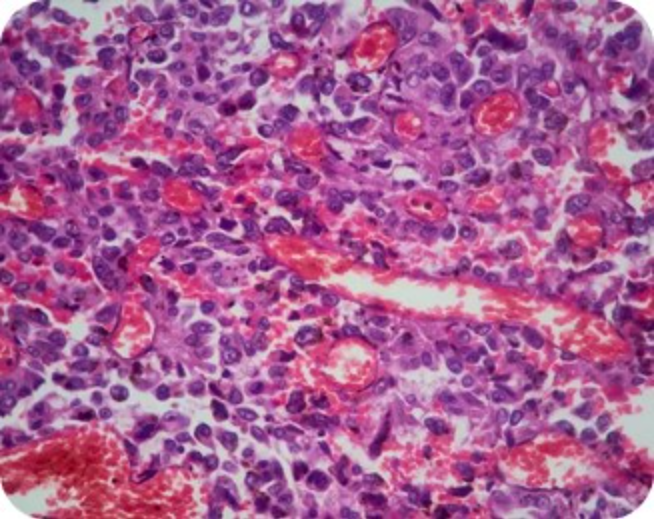 A histopathology slide of a hypercellular tumor with a prominent vascular pattern mobile