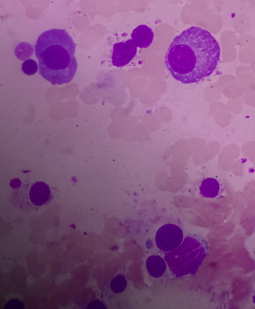 Illustration of multiple myeloma cancer cells