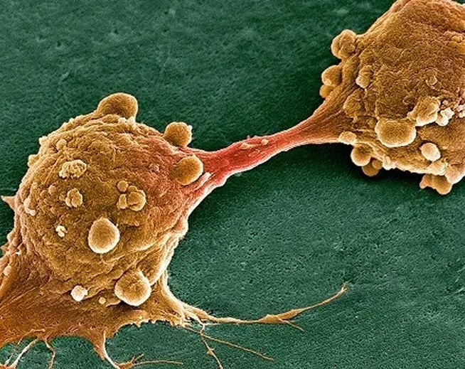 A colored scanning electron micrograph depicting two cancer cells in the process of dividing mobile