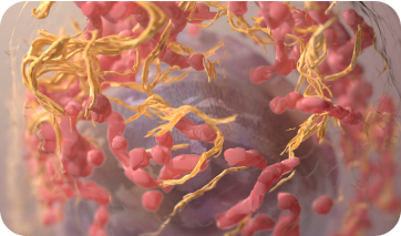 Illustration of skin cancer cells