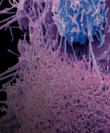 Illustration of prostate cancer cells