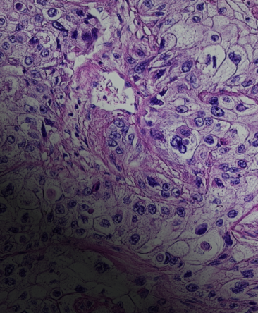 Illustration of cervical cancer cells