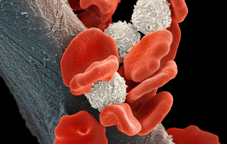 Blood cancer cells and blood cells