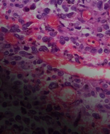 Illustration of cancerous cells in thoracic