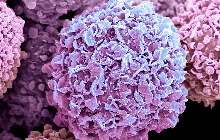 Breast cancer cell