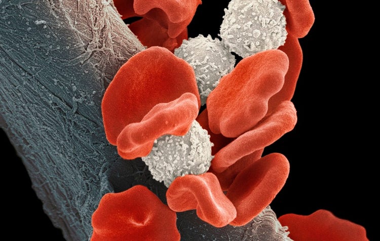 Blood cancer cells and blood cells, Picture