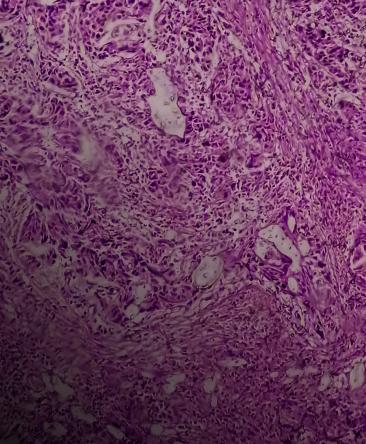Illustration of bladder cancer cells