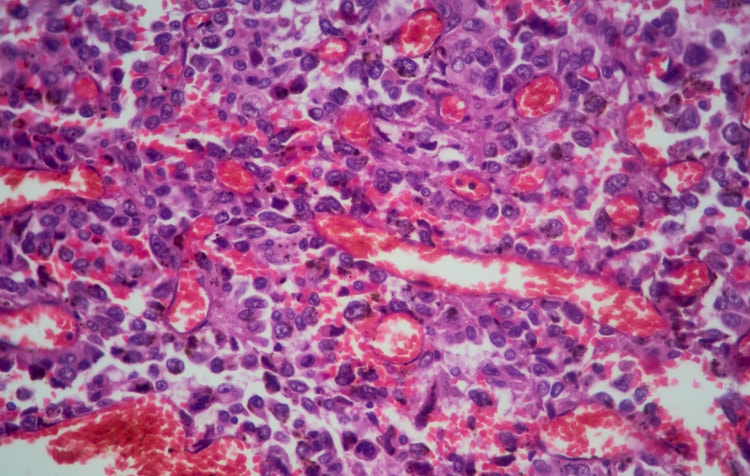 Thoracic Cancer Cells